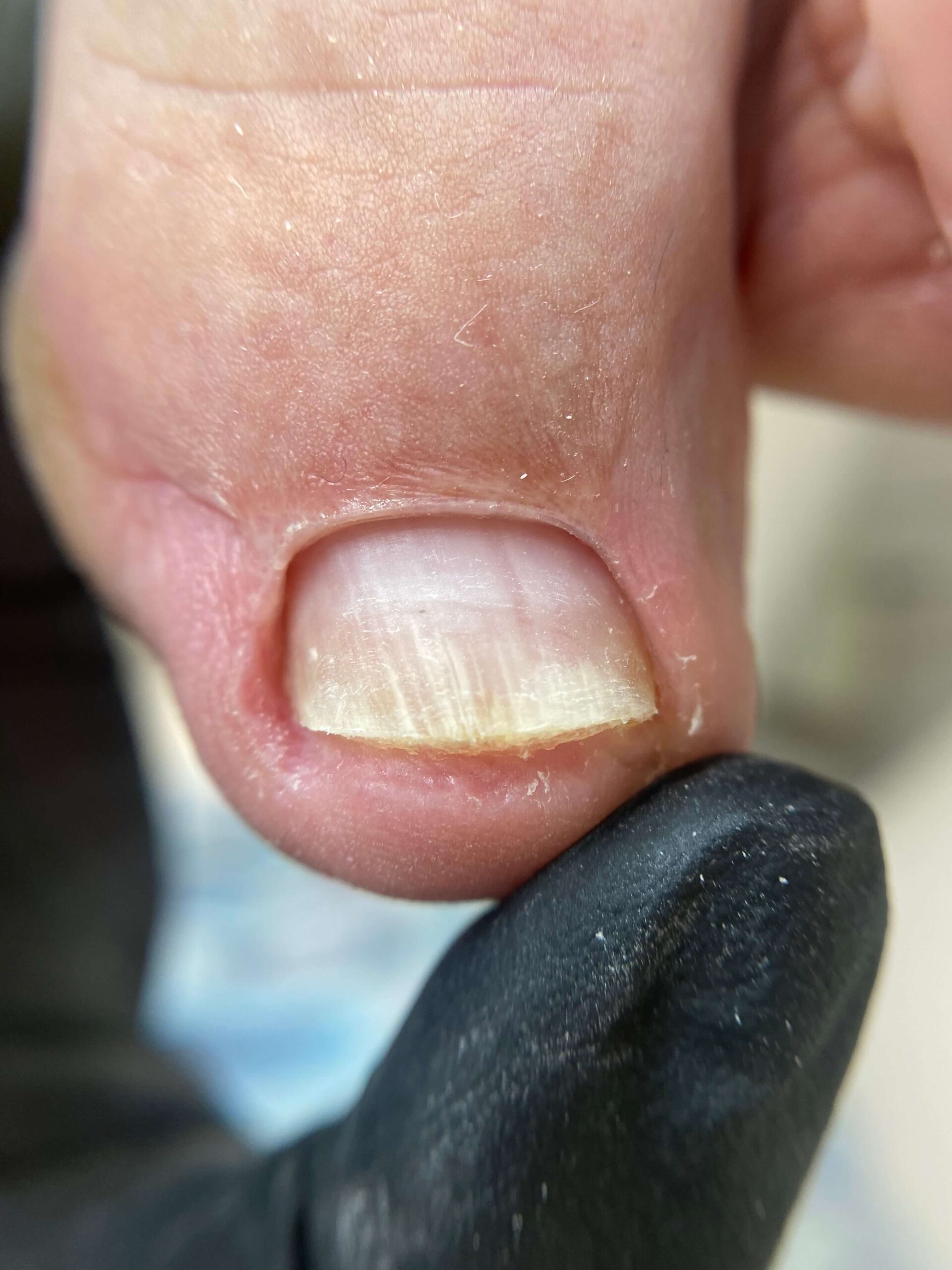 wrastajAcy paznokieA PO scaled